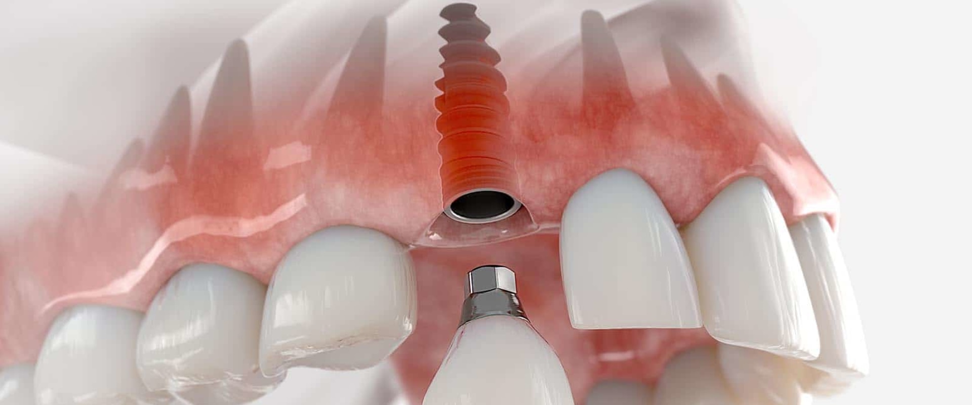 What to Do When You Have a Broken Dental Appliance