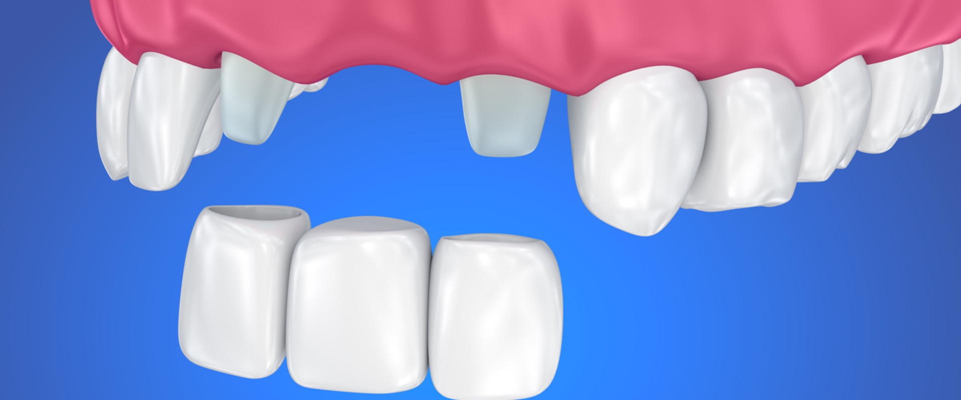 What to Do When You Lose a Filling or Crown