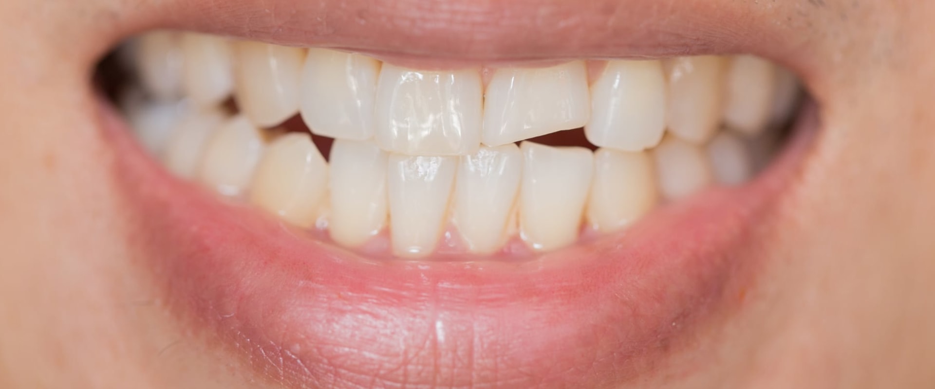 What to Do When You Have a Broken Tooth