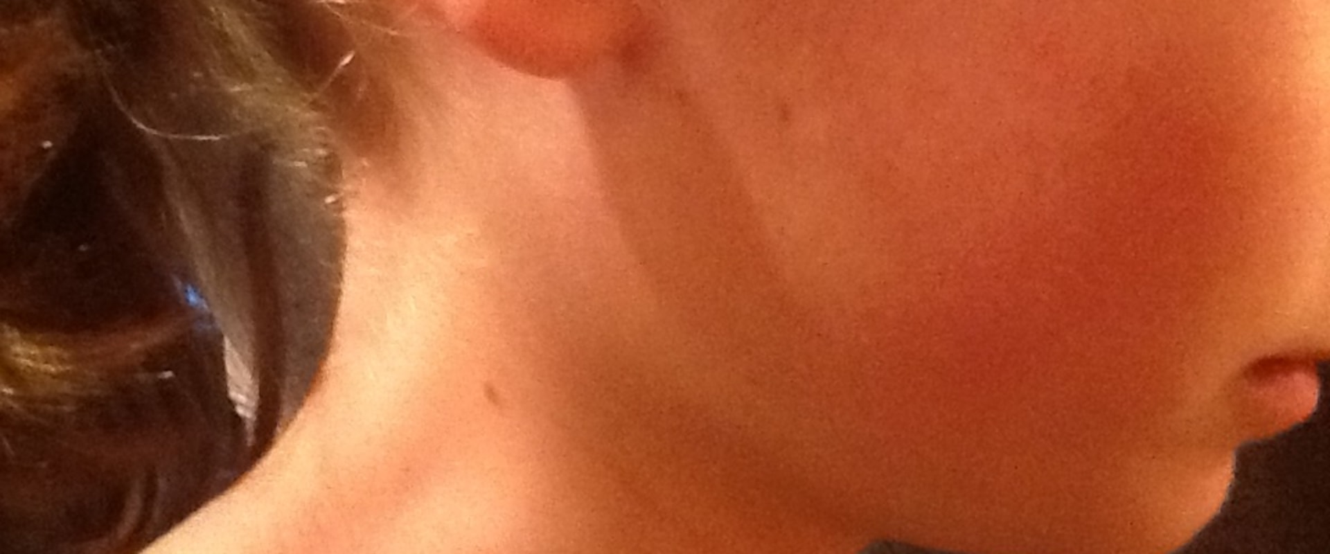 What to Do When You Have a Broken Jaw