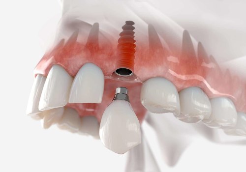 What to Do When You Have a Broken Dental Appliance