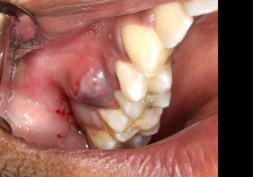 Can a Dentist Pull an Infected Tooth?