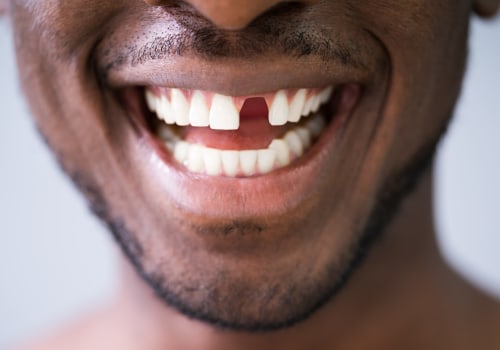 What to Do When You Have a Knocked-Out Tooth
