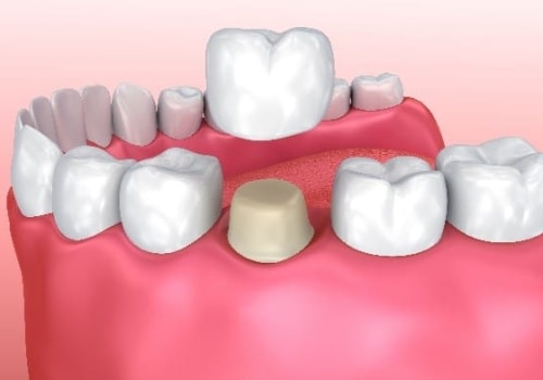 Can an Emergency Dentist Provide a Temporary Crown on the Same Day?