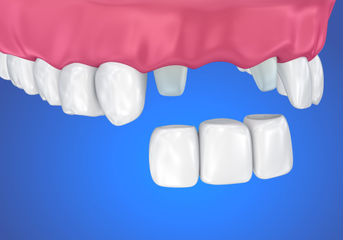 What to Do When You Lose a Filling or Crown