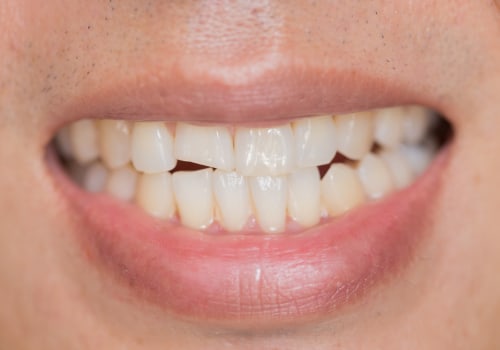 What to Do When You Have a Broken Tooth
